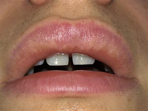 You want your lips to have a little time to heal from what was a treatment a minimally invasive one, but still a treatment that involved injections. . Tiny white spots on lips after filler
